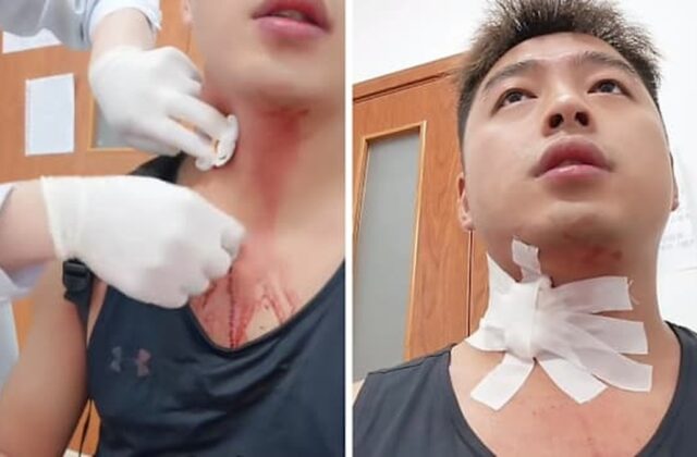 Câu Chuyện Hiếm Gặp: Hậu Quả Từ Một Cú Đập Muỗi Tại Cổ